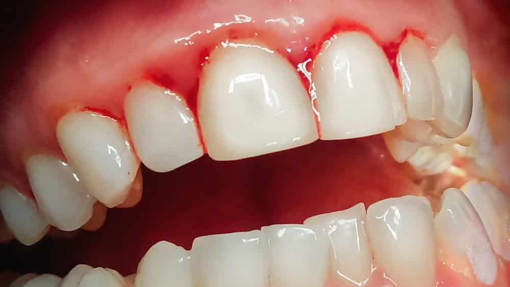 Gengiva avermelhada precisando de limpeza nos dentes - Allegra Odontologia